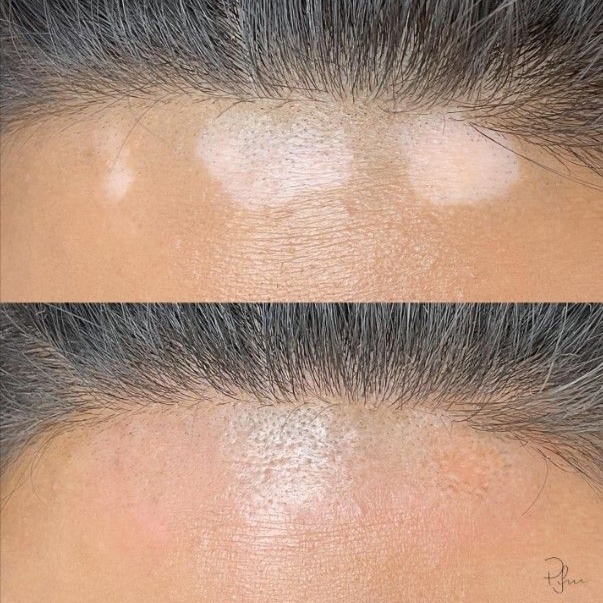 Custom Camouflage at Cosmetic Studio 54 in Los Angeles, CA