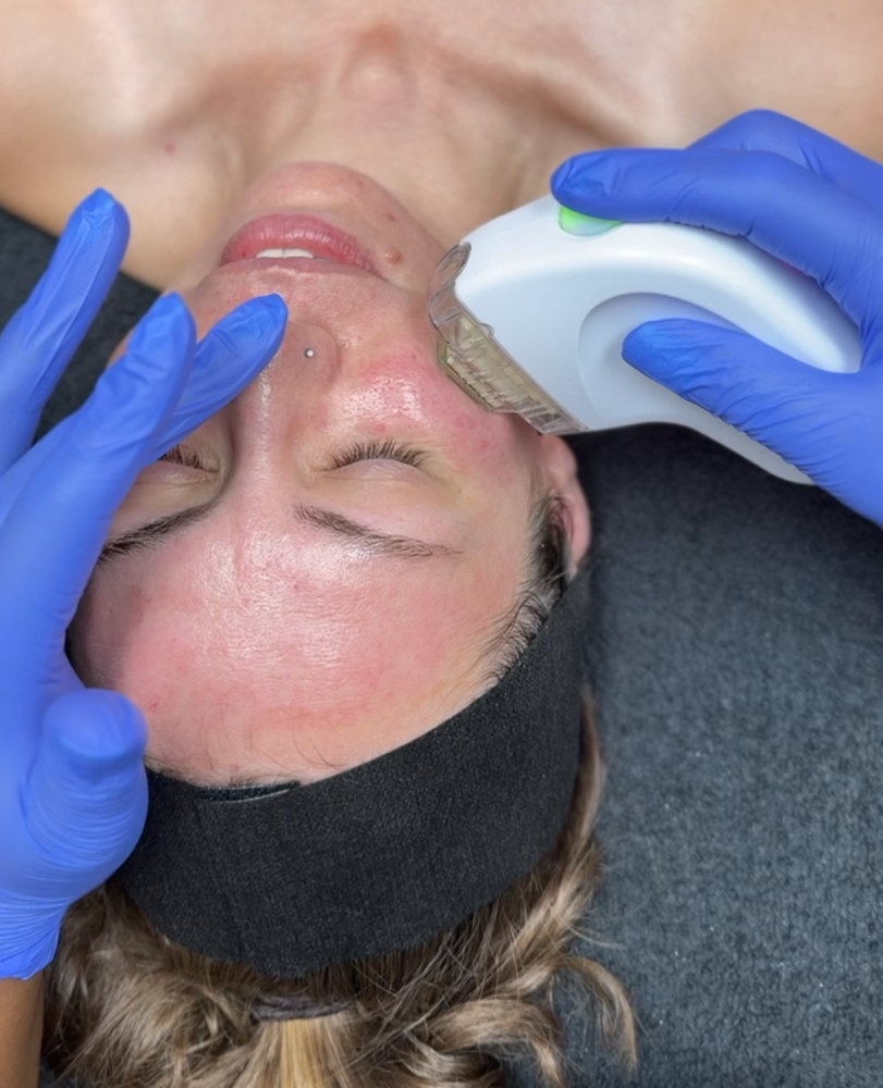 EndyMed Fractional Skin Resurfacing