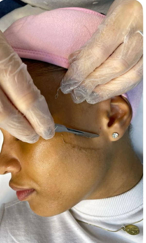 Dermaplaning Treatment