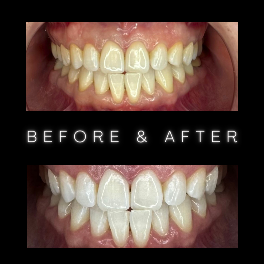 Teeth Whitening