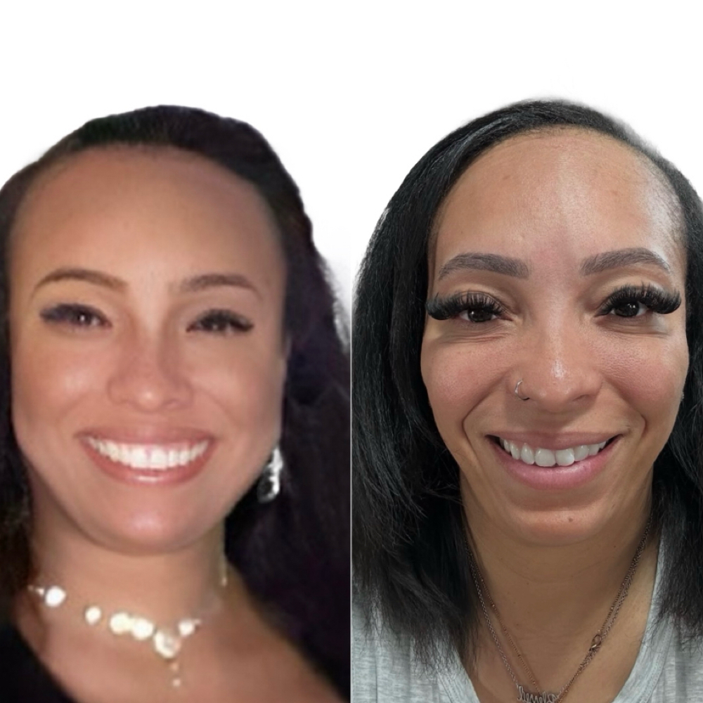 Masseter/TMJ Treatment at BlackBird Aesthetics in Fort Worth, TX