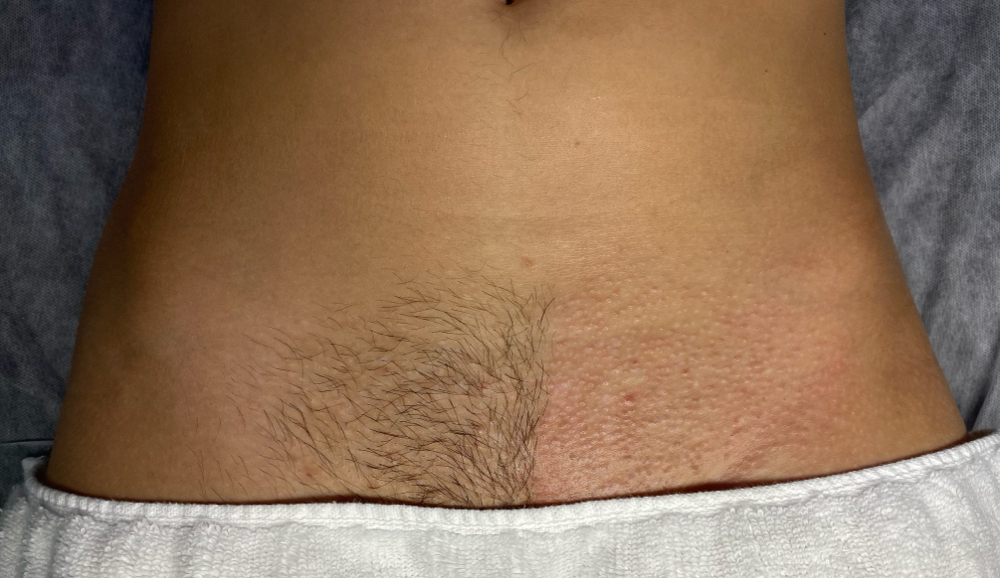 Female Brazilian Wax