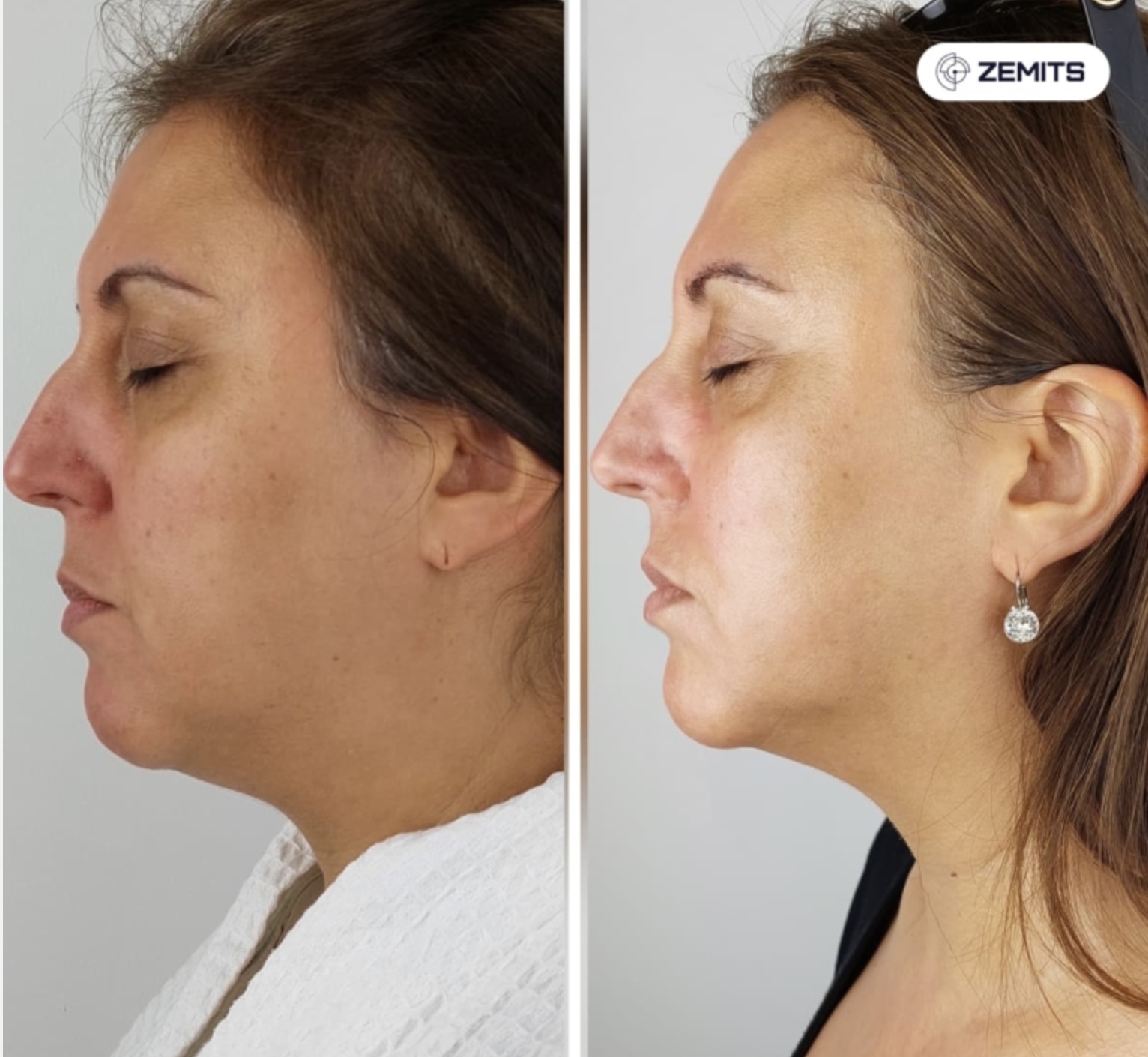 Add On : FrioLift Neck Treatment