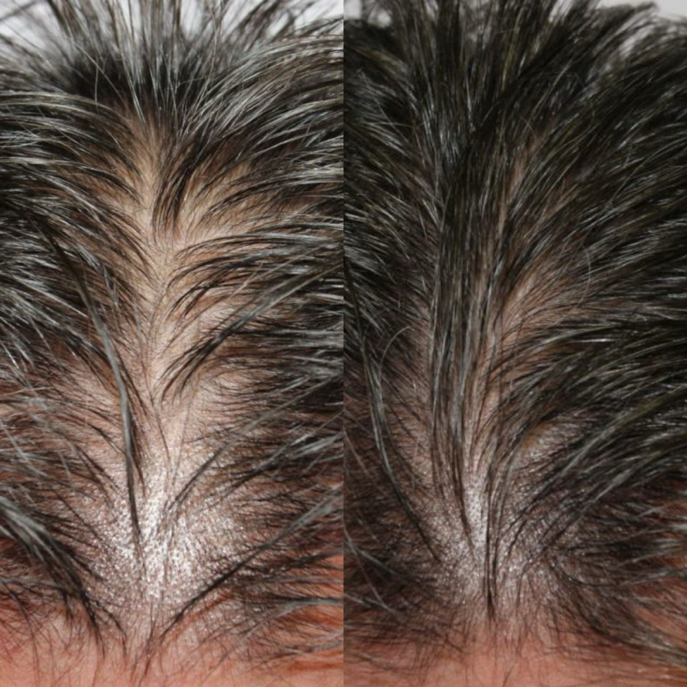 Exosome Hair Loss at Nather Skin in Hoboken, NJ
