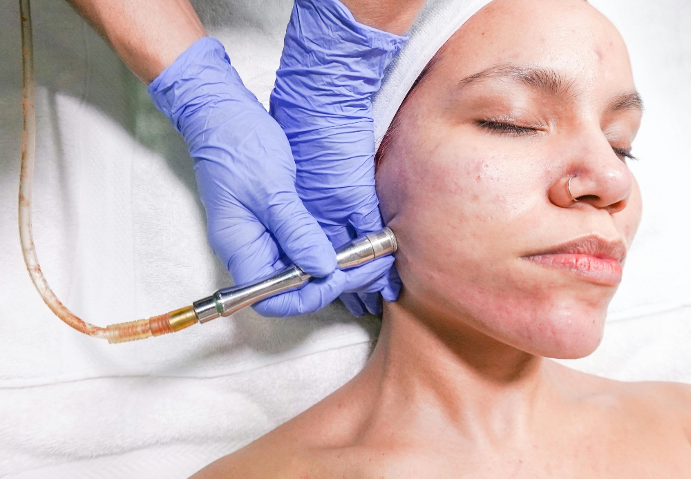 Microdermabrasion Facial
