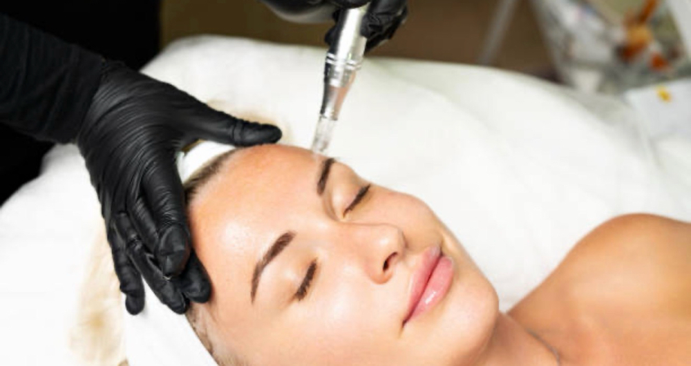 Microneedling at Glow Society in Highlands Ranch, CO