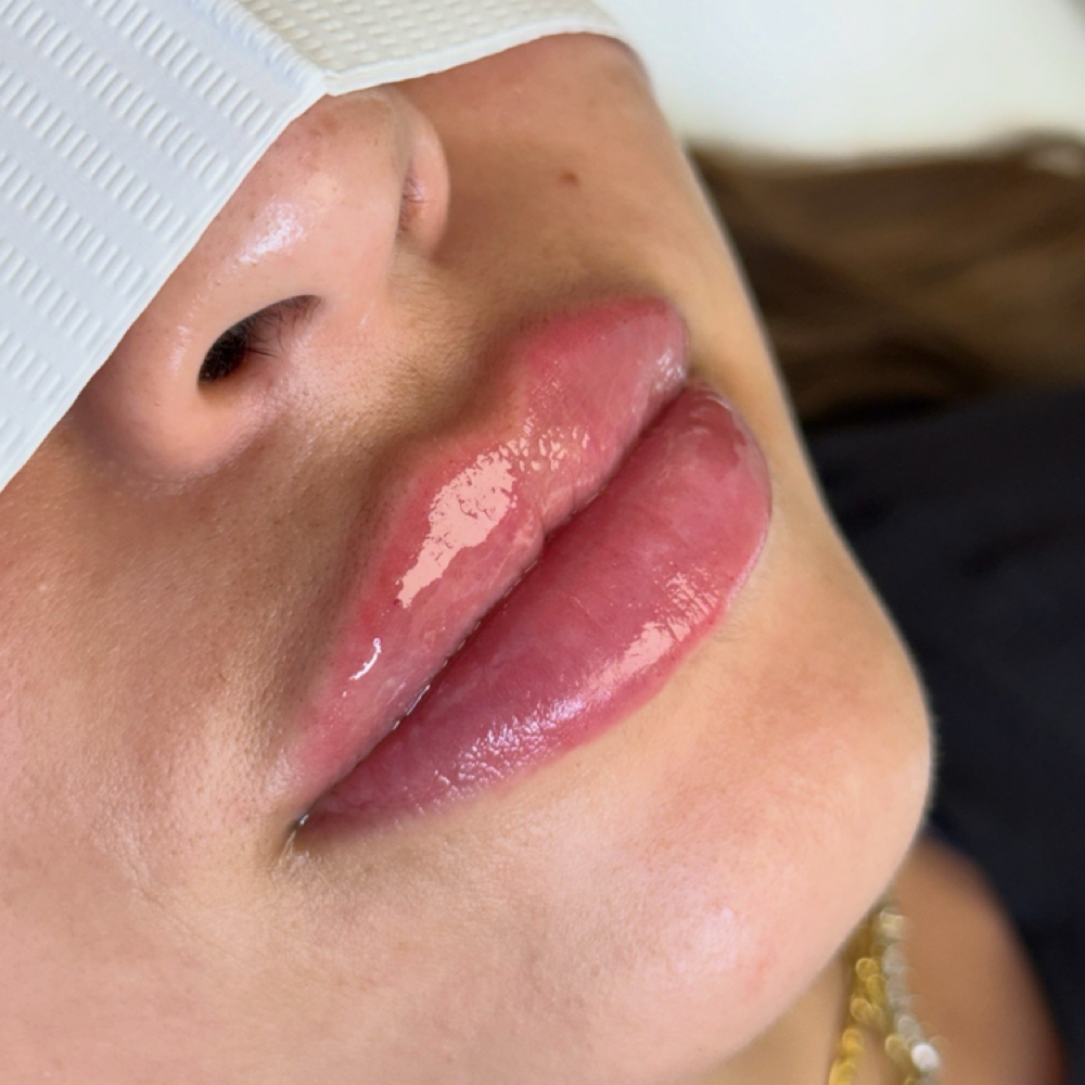 LIP FILLER at Aether Aesthetics in Midland, TX