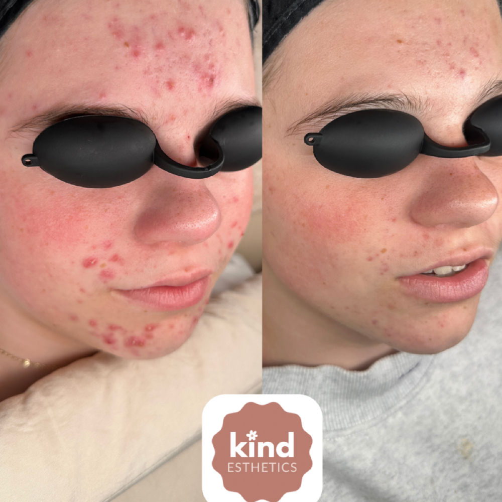 Acne Clearing Consultation at Kind Esthetics in Spring, TX
