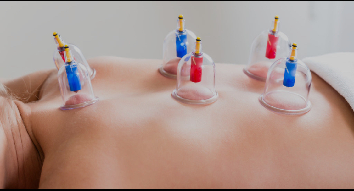 Cupping (myofascial release)