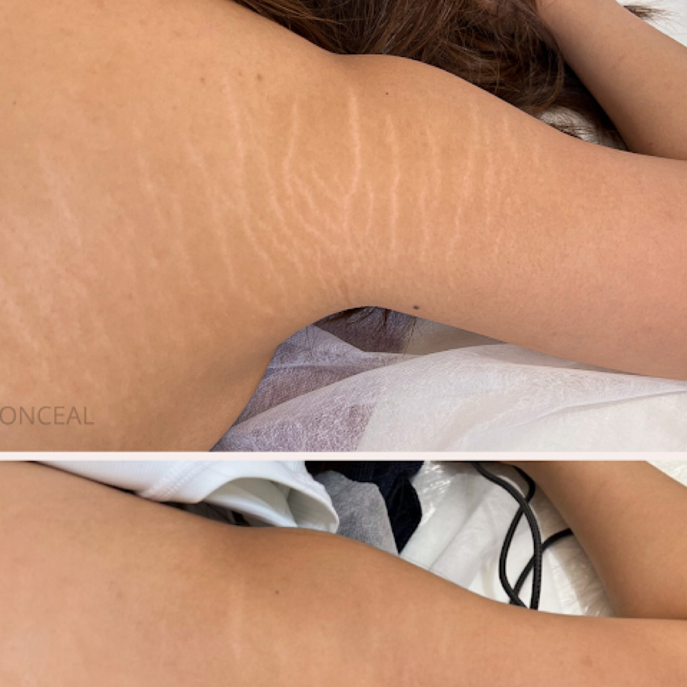 Camouflage Stretch Mark Revision at The Skin Babe Company in Montclair, CA