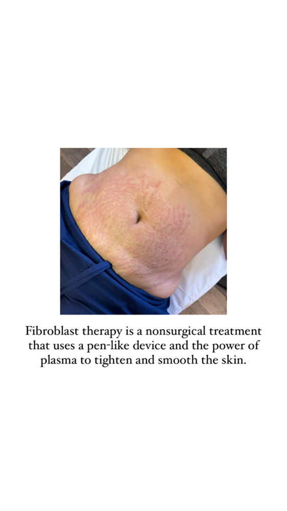 Plasma Fibroblast