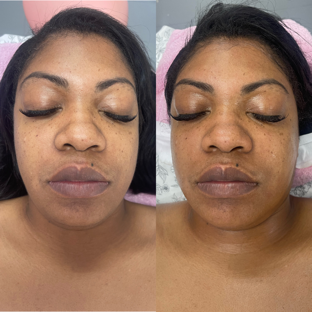 Dermaplaning With LED Light Therapy