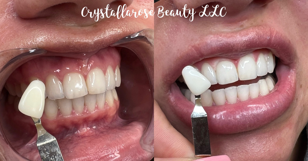 Professional Extreme Teeth Whitenin at Crystallarose Beauty in Erie, PA