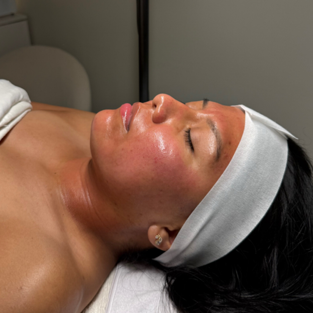 Microneedling with Salmon DNA PDRN at SKNFORM in Phoenix, AZ
