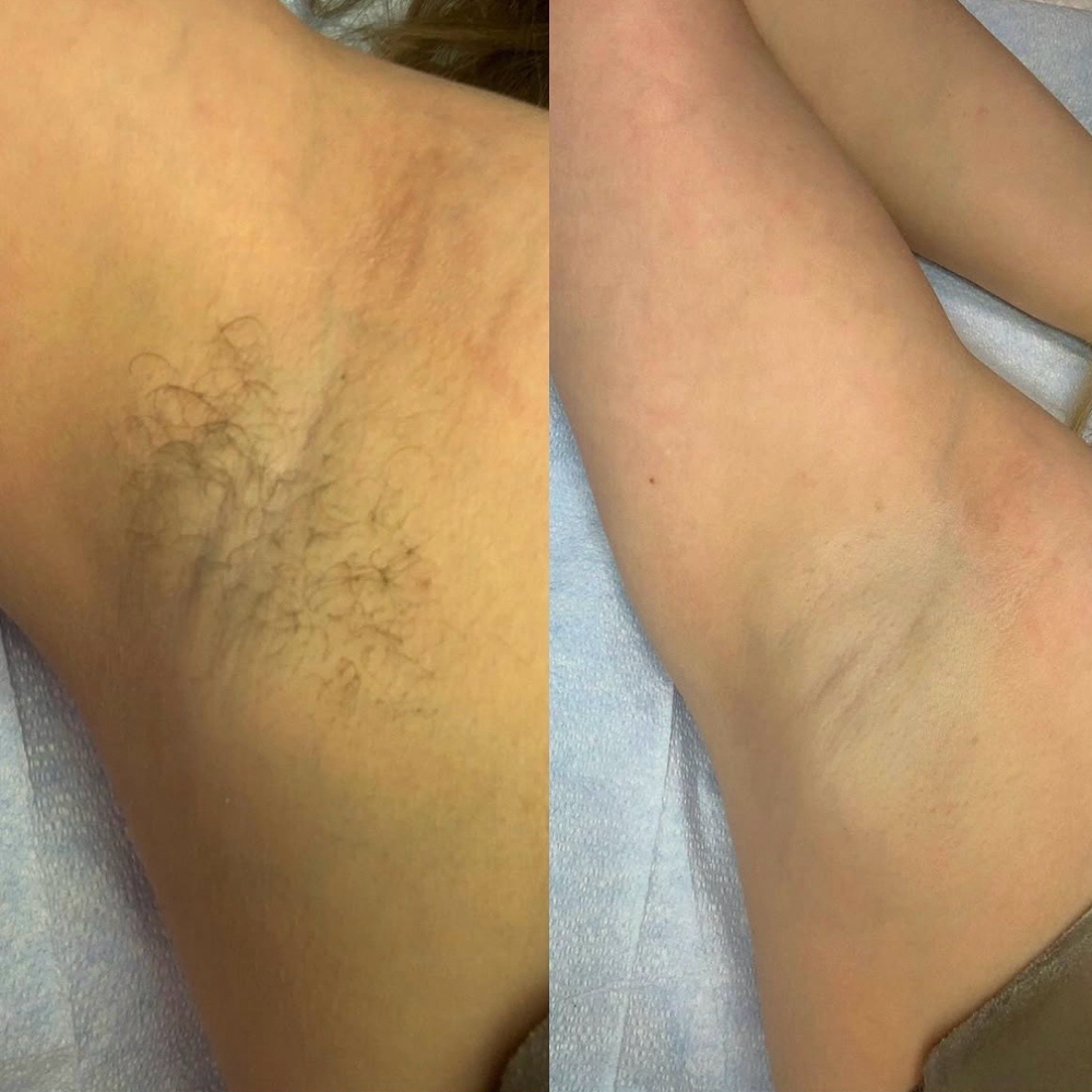 Underarm at Honey Bee Smooth in Richmond, KY