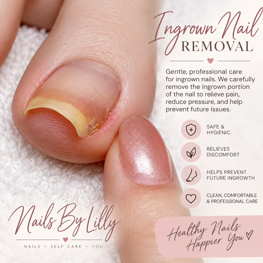 Ingrown Nail Removal at Nails By Lilly in Mineral Ridge, OH
