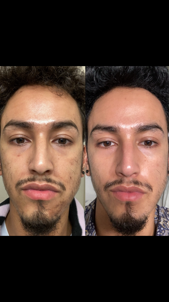 Chemical Peel