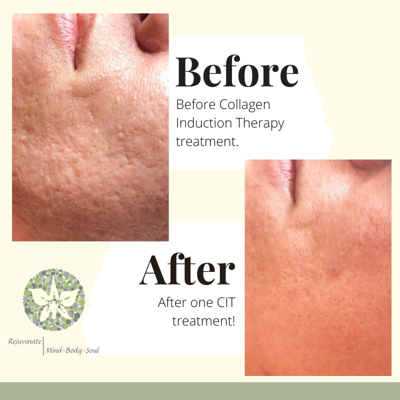 CIT Microneedling