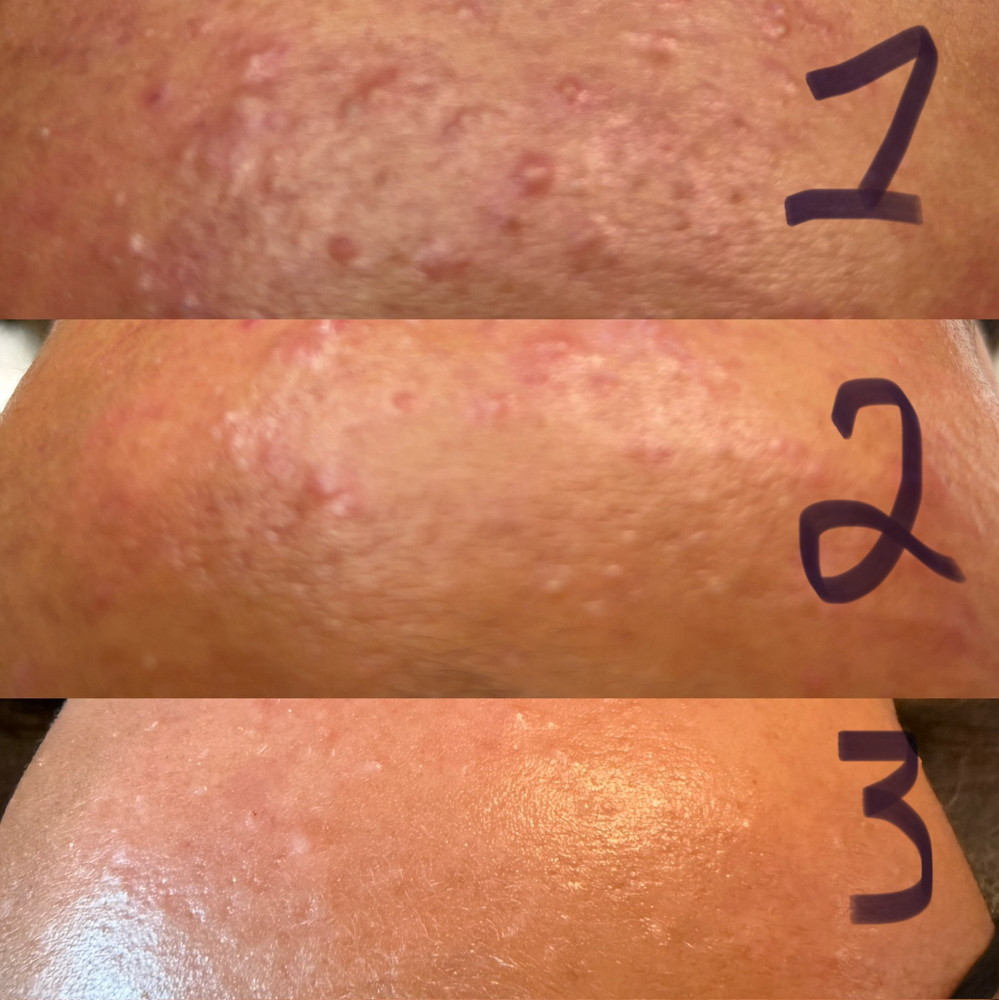 Teen/Acne Facial at Love and Hair in Cheney, KS