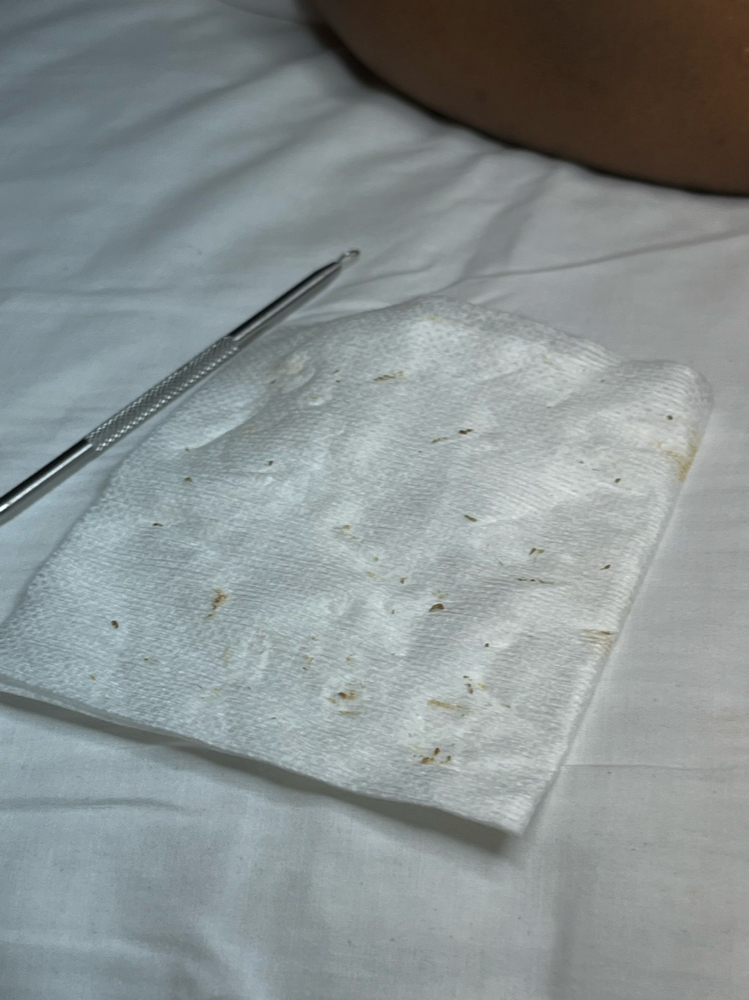 Deep ingrown Removal & Extractions