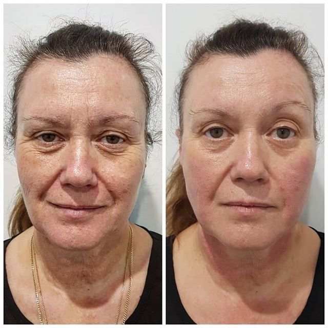 SMAS Lifting Facial