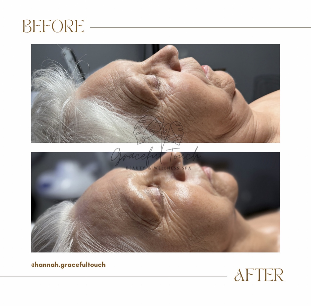 Fibroblast Radiance Lift