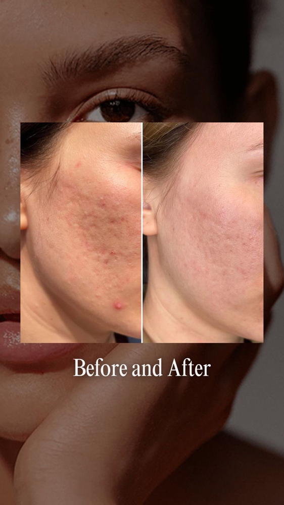SUBLATIVE Skin Resurfacing