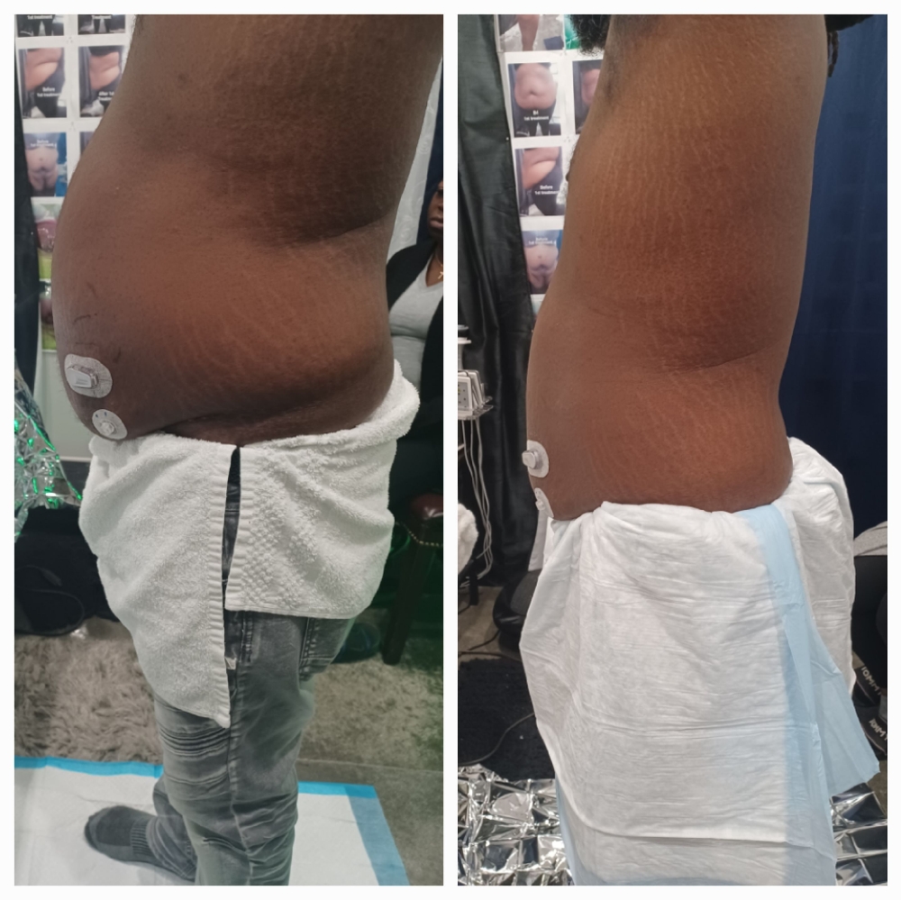 4 Session 💜 Stomac Lipo Cavitation