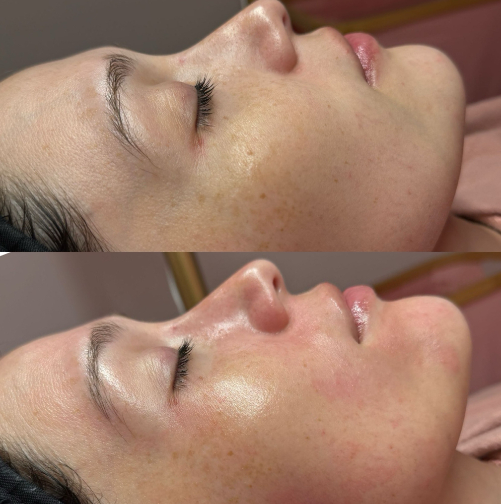 AlphaRet Peel 30 🧪 at Cereza Skin and Laser in Tempe, AZ