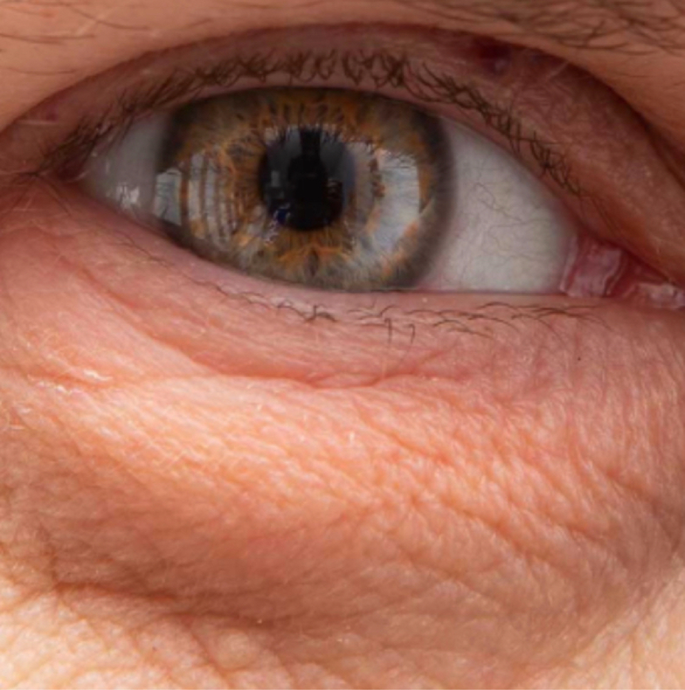 Eyebag Peptide Treatment Package at Red Carpet Luxury spa in Modesto, CA