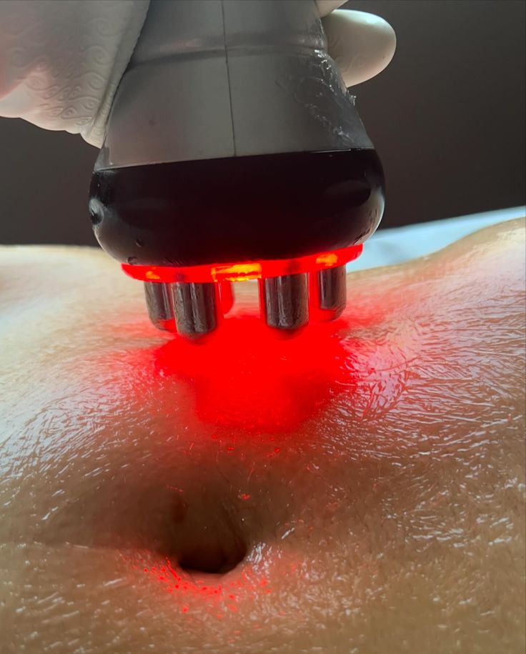 Cavitation, RF and EMS Treatment