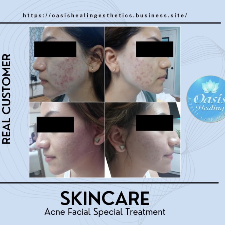 Chronic Acne Facial Treatments at Oasis Healing Esthetics in Los Angeles, CA