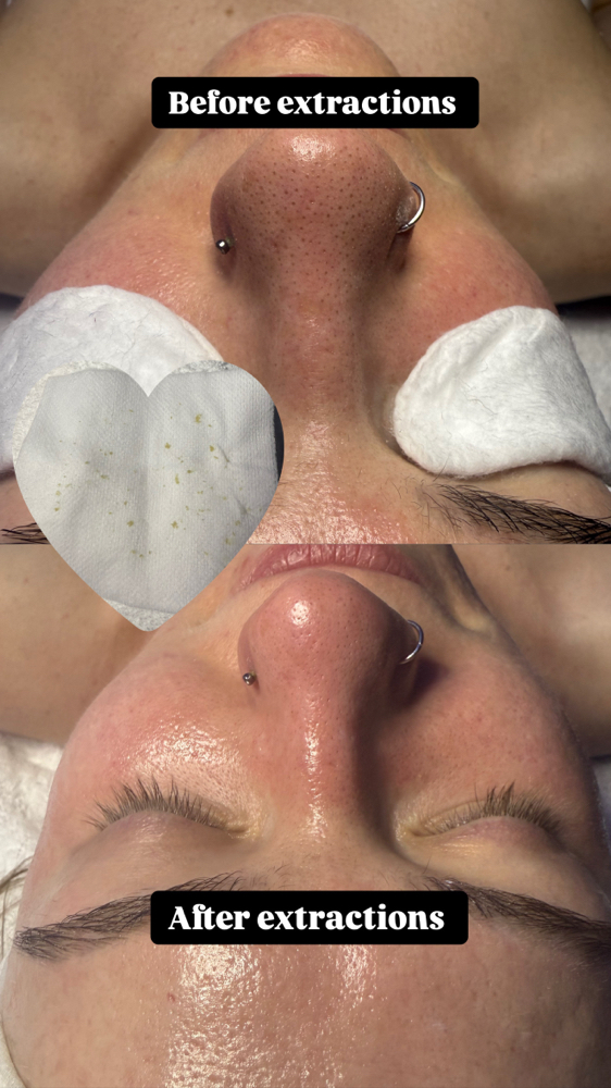Detox Facial