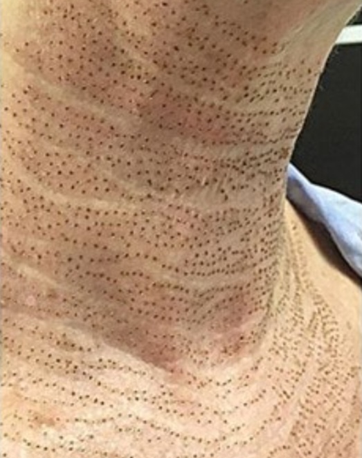 Plasma - neck