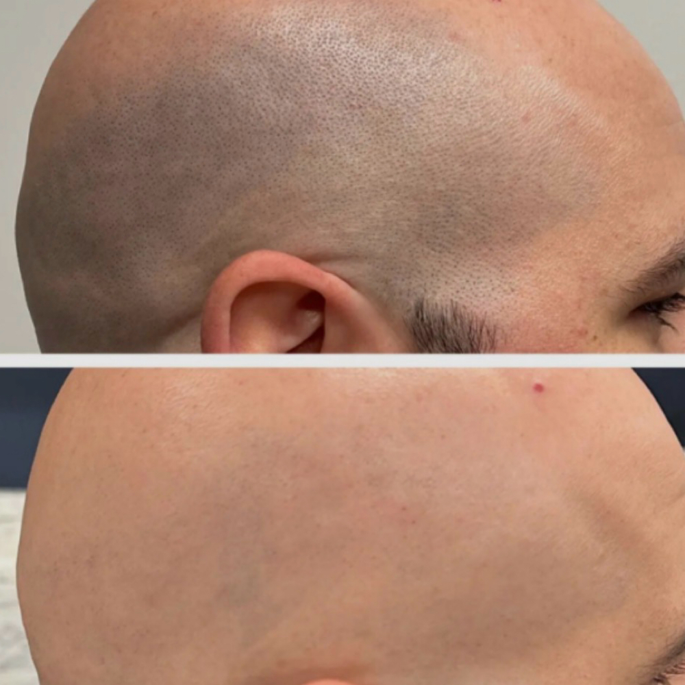 Head Hair Removal Single Session at Blessed & Bare Laser Studio in New York, NY