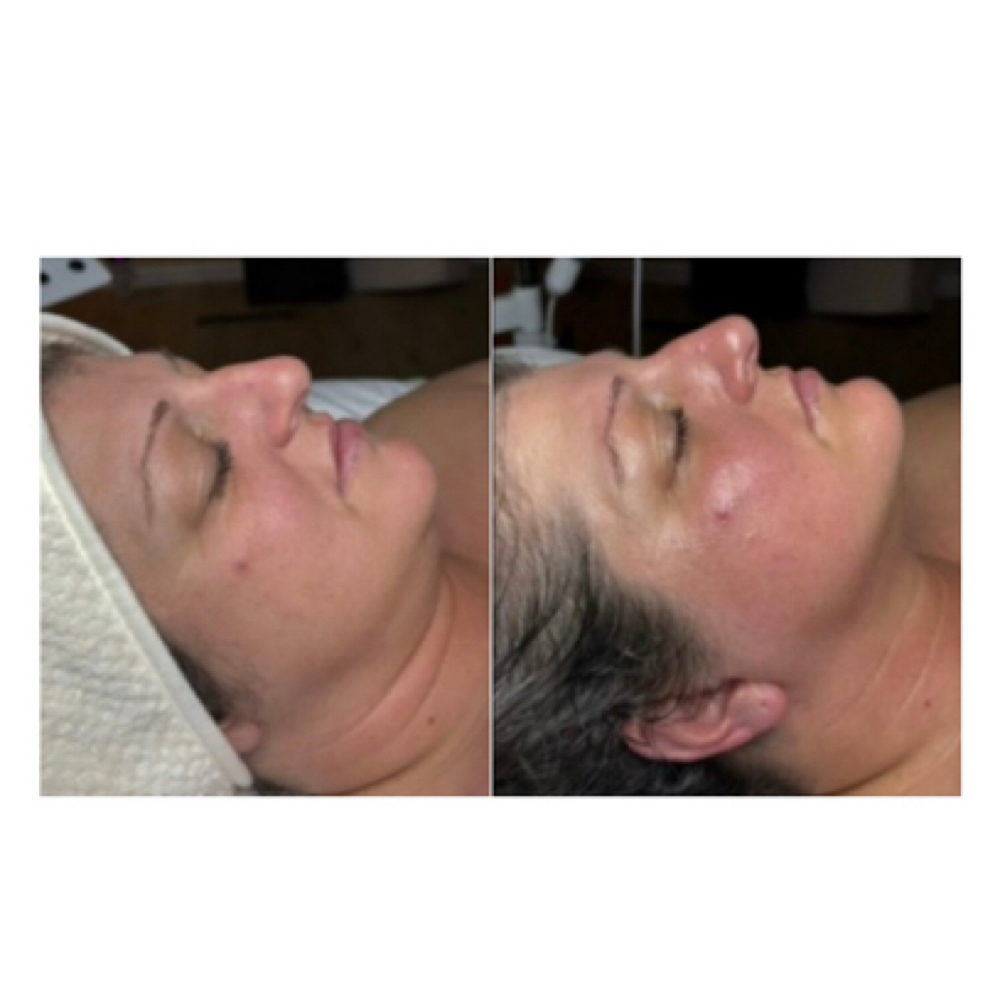 Facial Lymphatic Drainage Massage at Softer Skin Esthetics LLC in Sedalia, MO