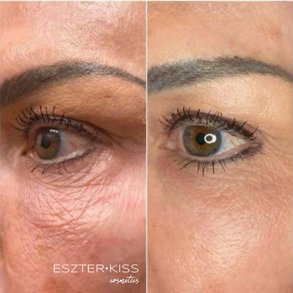 Under Eye- Plasma Fusion at Eszter Kiss Cosmetics in Deltona, FL