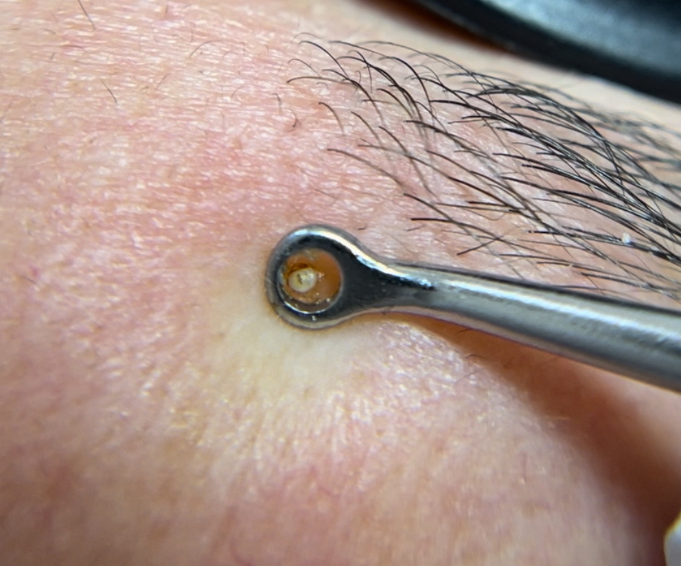 MILIA REMOVAL