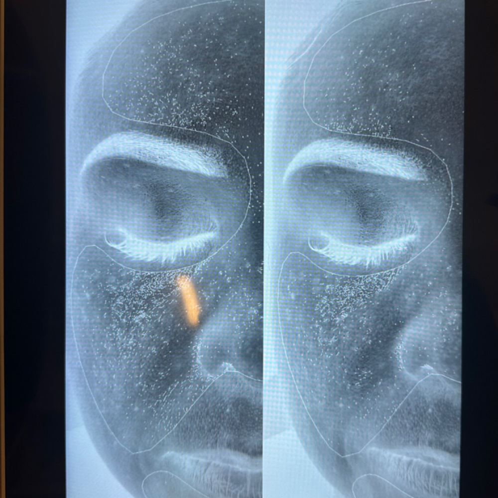 Skin Mapping at Skinbar by Nicole in Redwood City, CA