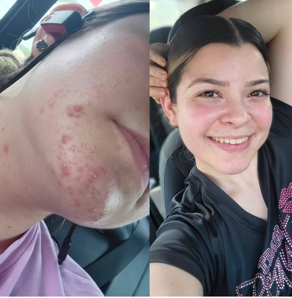 Acne Consultation With Facial at Born Beaute in Mission, TX