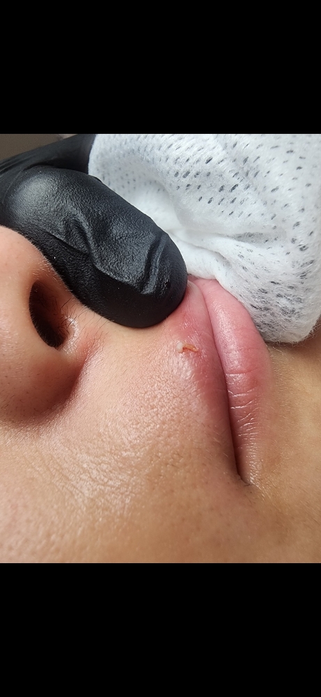 Teen Facial at Morning Glow Esthetics in Palm Desert, CA