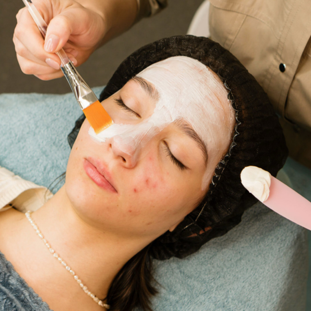 Advanced Acne Peel at SKINDESIGN BY SAM D. in Massapequa, NY