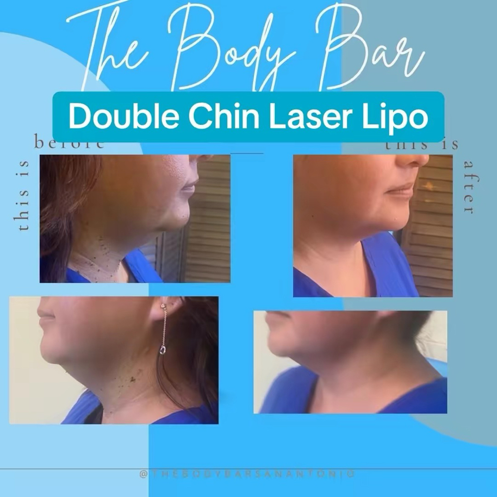 Double Chin Laser Lipo - 2 session at 210 The Body Bar | San Antonio Lux Spray Tans & Body Sculpting in San Antonio, TX