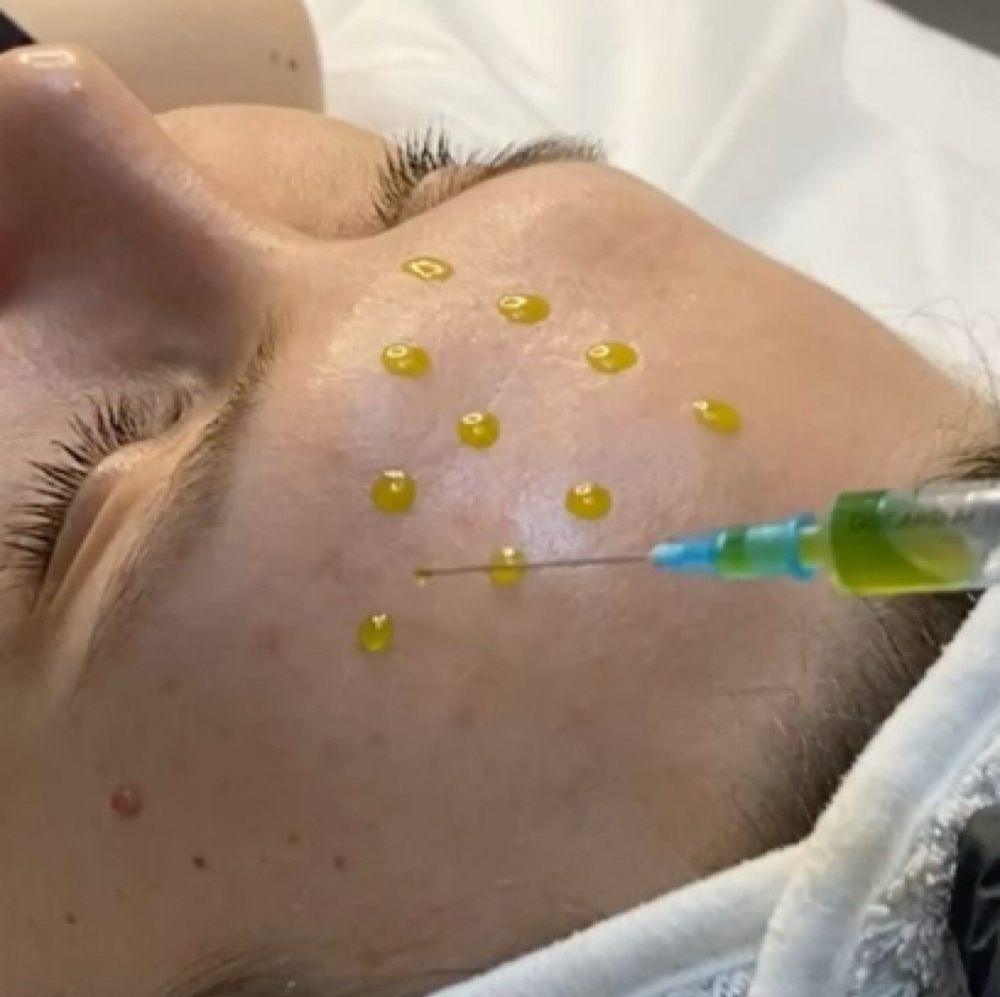 Lumiphase Peel - Summer Safe Peel at Adelina Aesthetics in Old Bridge, NJ