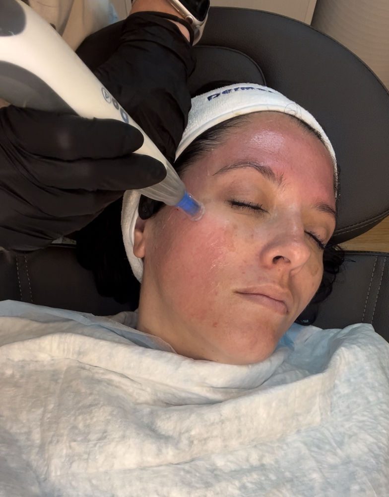 Microneedling DermaPen w/ PRF