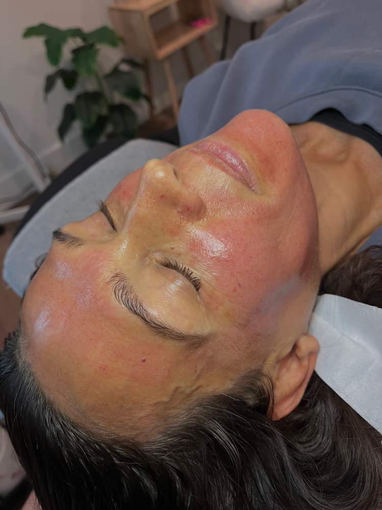 Package Of 3 Deluxe Microneedling