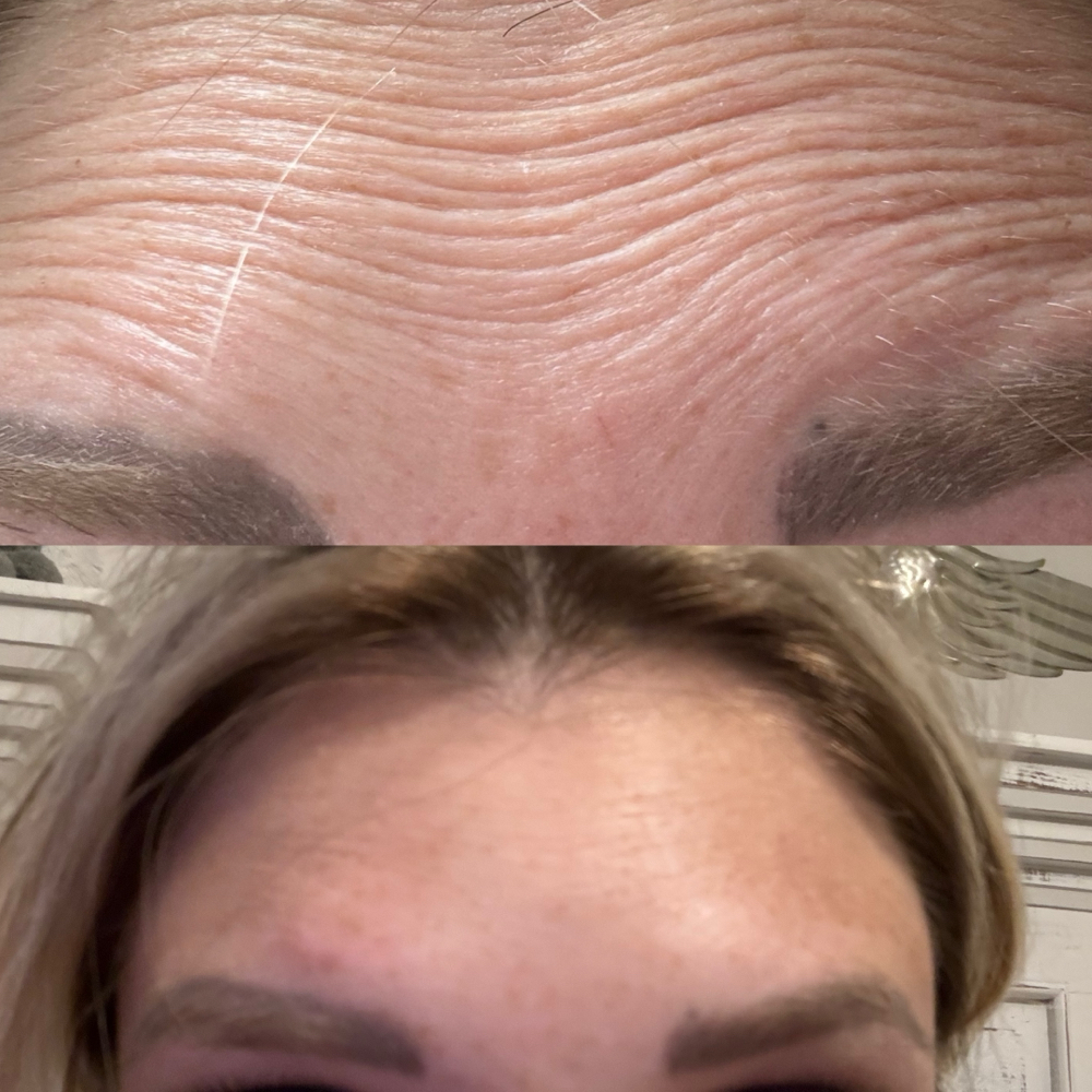 Botox (Full Face) Up To 50 Units