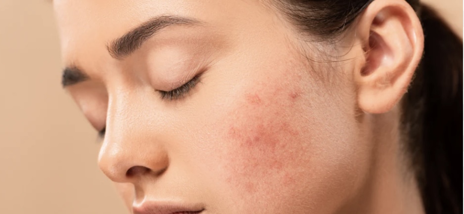 ACNE MICROBIAL DETOX FACIAL