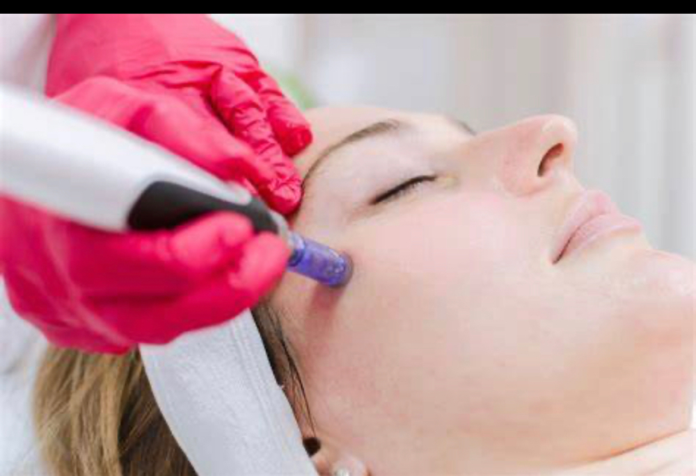 Microneedling