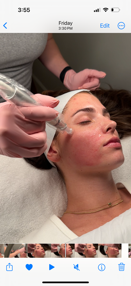 Microneedling Neck & Chest Add On